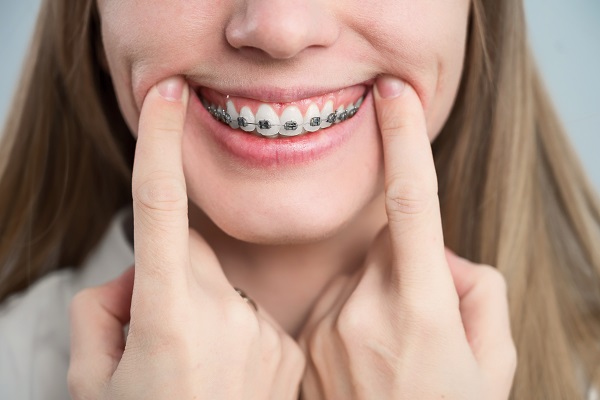 How Often Do Braces Need To Be Tightened?