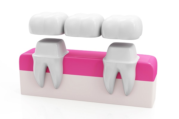 Repairing  Gaps With A Dental Bridge