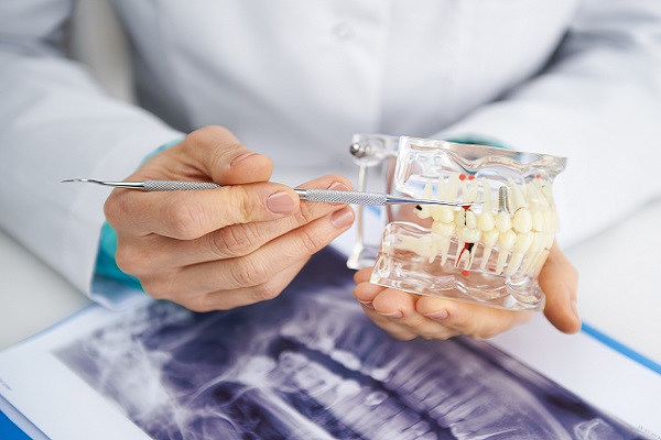 How Does A Dental Filling Procedure Work?
