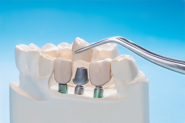 Bone And Gum Grafting Before Dental Implant Placement
