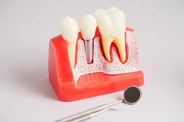 How To Take Care Of Dental Implants 