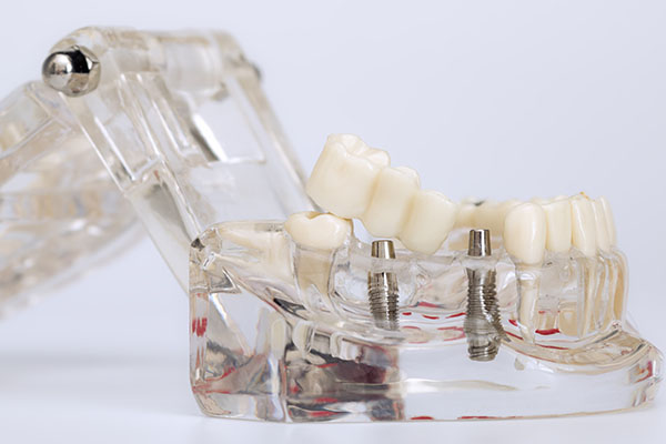 Advantages And Drawbacks Of Implant Supported Dentures