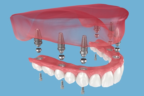 Care Tips For Implant Supported Dentures